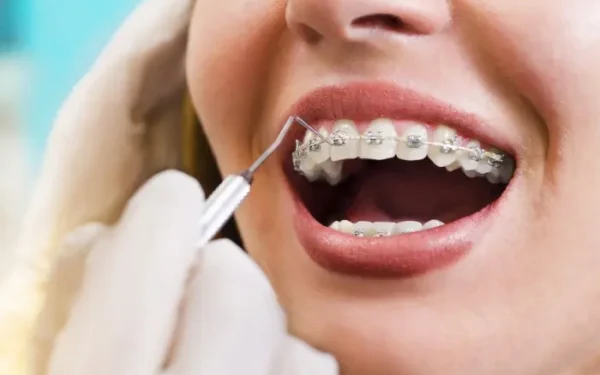 10 Benefits of Installing Braces to Improve Oral Health