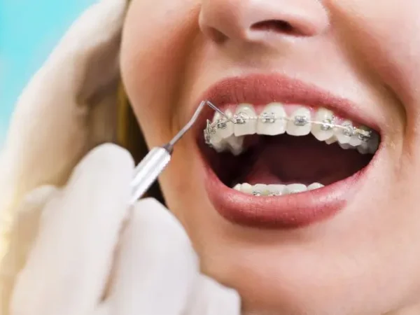 10 Benefits of Installing Braces to Improve Oral Health