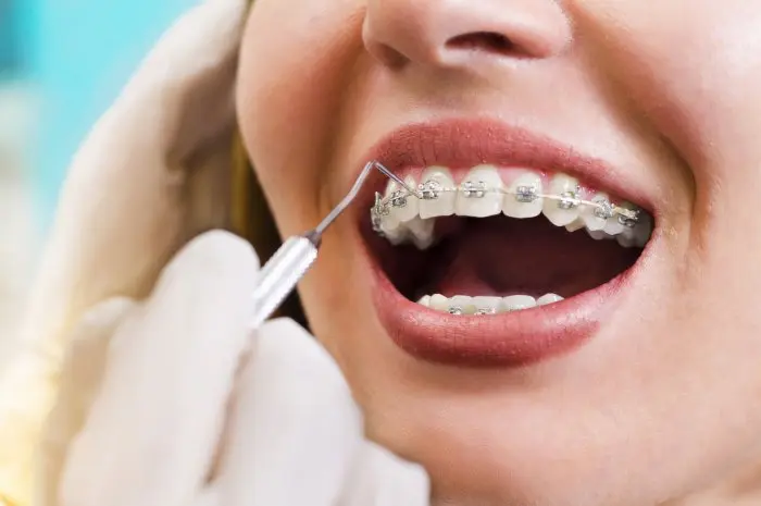 10 Benefits of Installing Braces to Improve Oral Health